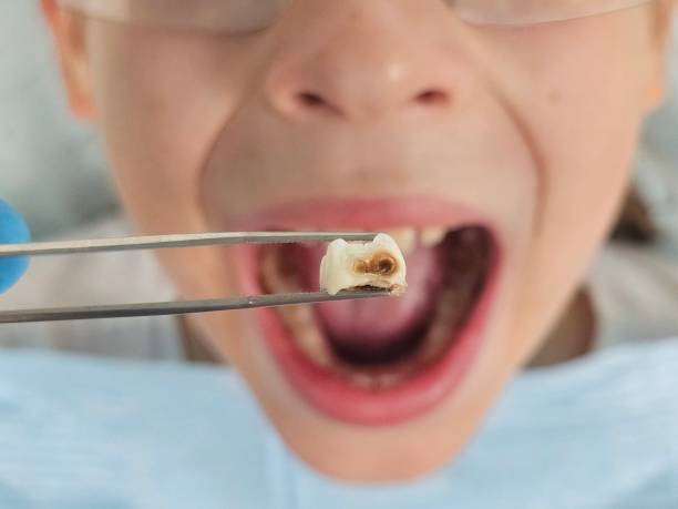 Best Emergency Wisdom Teeth Removal in Volcano Golf Course, HI